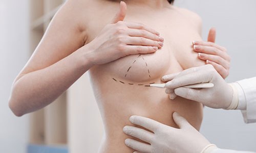 Nâng ngực ổn định nhất khoảng bao lâu?